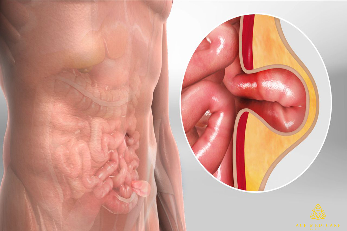 The Different Types of Inguinal Hernia Explained